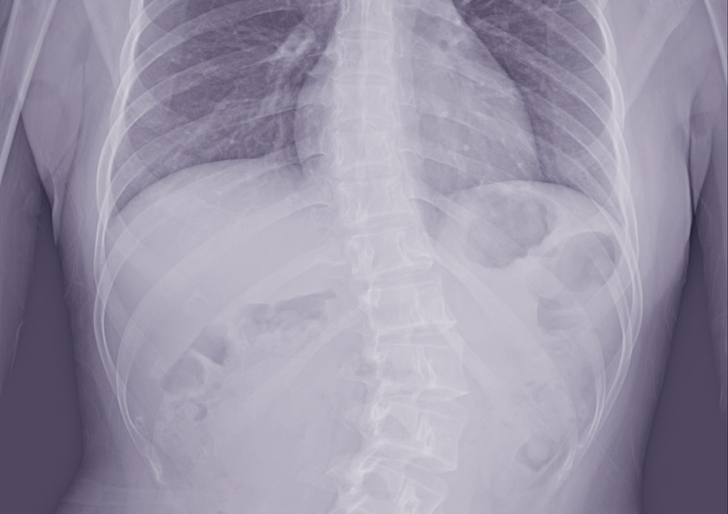 My Experience With Scoliosis